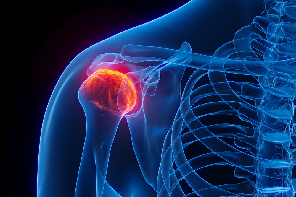 Stratégies de traitement des douleurs de l’épaule